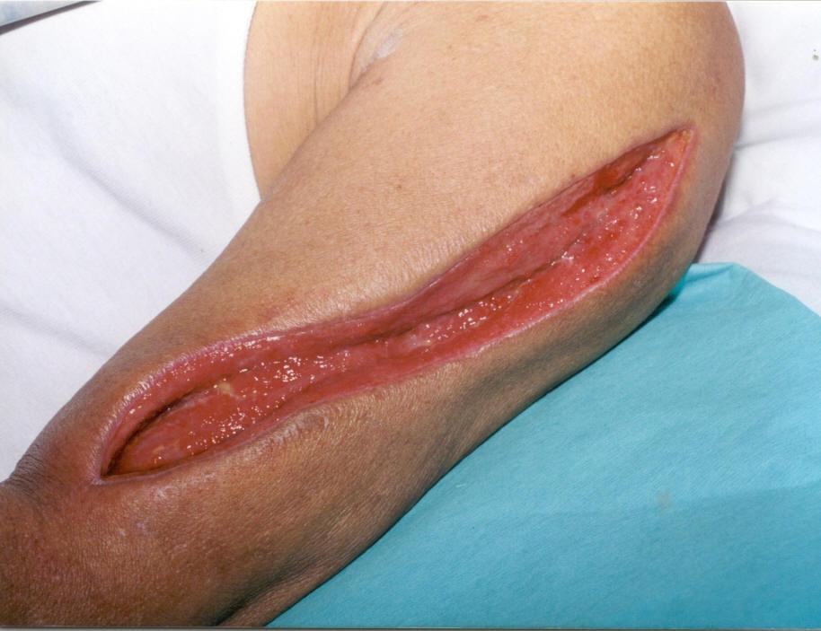 Minimal oozing from wound base, blood clots ; minimal slough at wound base. Exposed muscle.