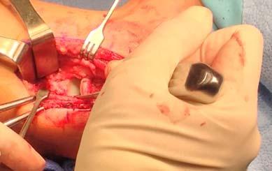 CASE New humeral single tunnel