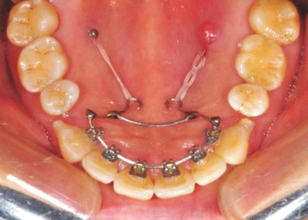 Jang and Lee: A Sequential Approach for an Asymmetric Extraction Case in Lingual Orthodontics line coincided with facial midline.