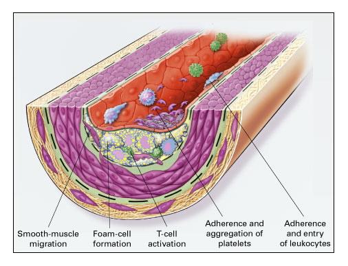 Figure 1-1. Fatty-Streak Formation in Atherosclerosis a Platelet adhesion is another characteristic of the atherosclerotic process.
