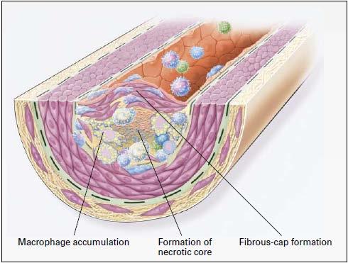 Continued proliferation of smooth muscle cells and intracellular matrix produce the definitive plaque, covered by a fibrous cap (pictured in Figure 1-2).