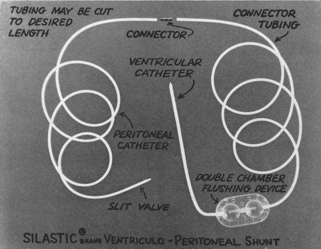 Ventriculo-Peritoneal Shunts 5~7 FIG. 1. Assembled apparatus for silastic ventriculo-peritoneal shunt.