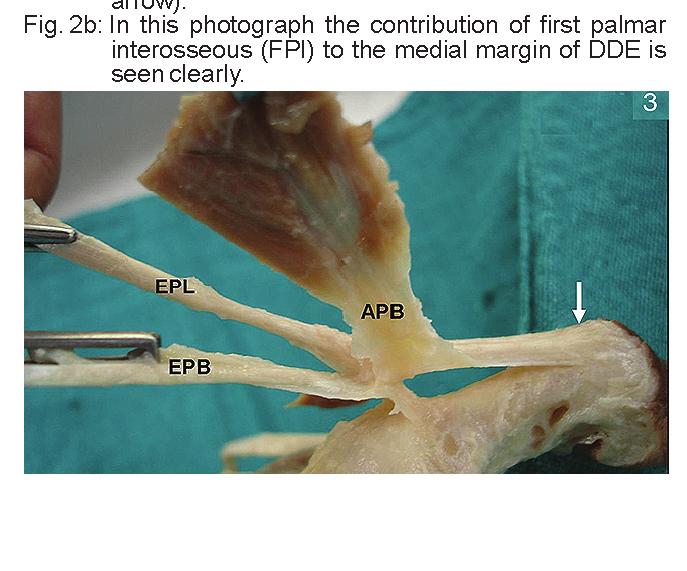 Its transverse head also gave fibres to e medial margin of DDE in about 8 % specimens examined. In 62.7 % fibres of first palmar interosseous could also be traced to e medial margin of expansion (fig.