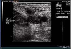 Venous Ultrasound Detects DVT in 13-15 % of patients with suspected PE and 29% of patients with proven PE Useful adjunctive study when the results of CTA or