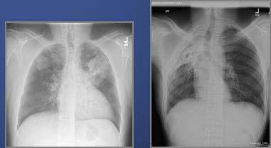 Tuberculosis Chest X-ray Findings Active Disease Infiltrates or cavitary lesions