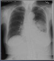 Case 2 Continued 75 year old female Difficulty breathing and cough T 101.