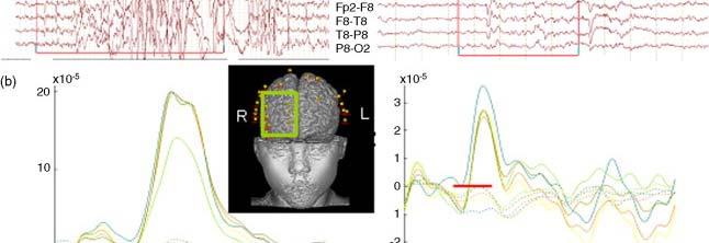 11/8/2013 23 EEG-NIRS NIRS optically measuring the changes of concentrations of oxyhemoglobin to support h l bi and d