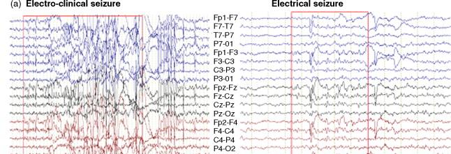 Compared to EEG-fMRI, the integrative analysis of EEG-NIRS for understanding the underlying mechanisms in neurovascular coupling