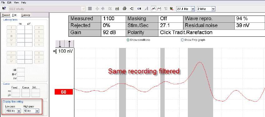 AEP recordings! The Eclipse offers two different filtering methods that can be applied and used in this way: 3.13.
