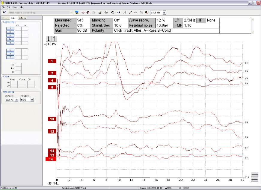 EABR Short description: Work Area: Electrode montage: Results: EABR EABR test used together with a Cochlear Implant system.
