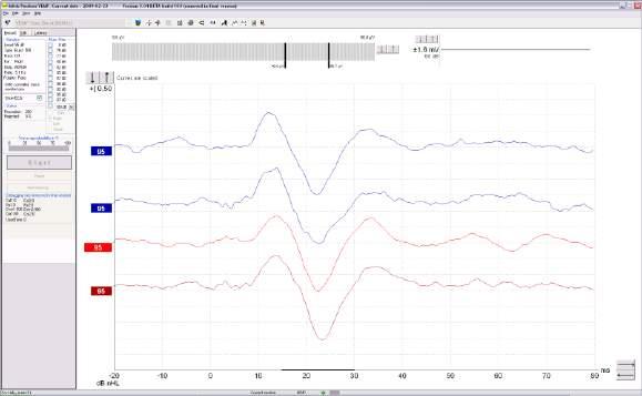 Figur2: Scaled EMG curves Under the edit tab if needed it is possible to view the