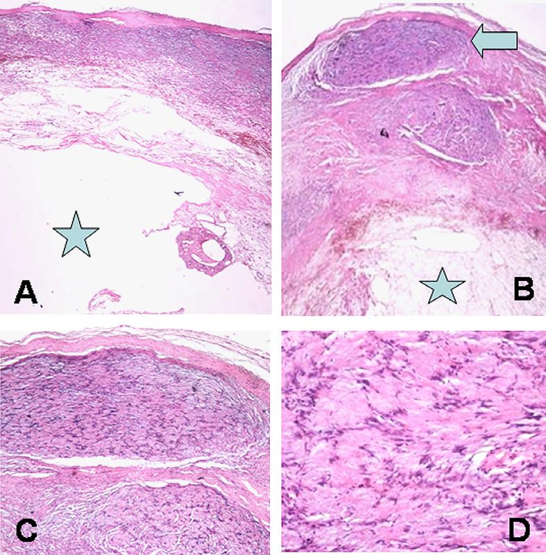 Tumor cells composed of proliferating groups of palisaded Schwann cell nuclei in Antoni A tissue (B, 40 & C, 100) forming Verocay bodies (D, 100) were noted at the periphery of the mass.