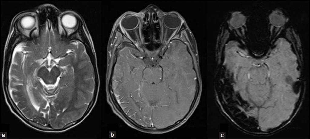 Sturge-Weber Syndrome Superficial lesions Encephalotrigeminalangiomatosis Non-hereditary, GNAQ gene mutation