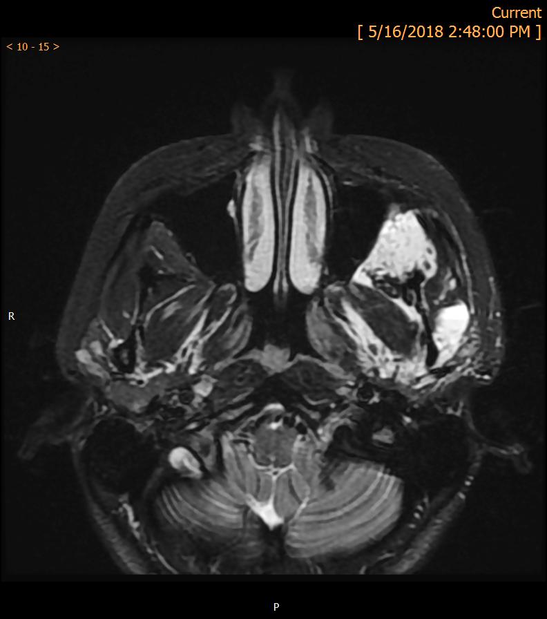 birth Imaging not necessary for diagnosis MRI- STIR & T1-FS postcontrast Facial CM: Brain MRI to assess potential