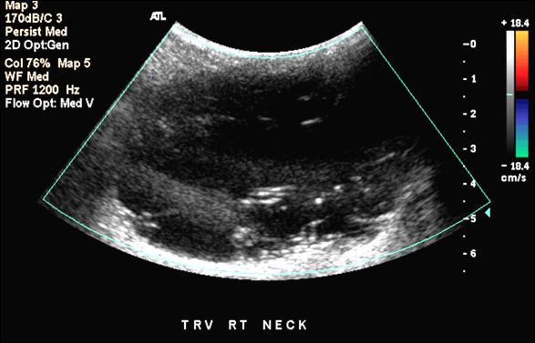 LM with macrocysts - ultrasound