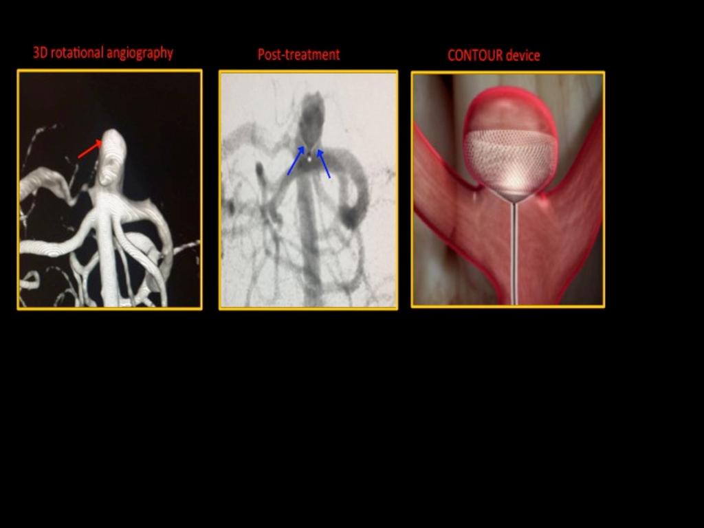 Fig. 5: CONTOUR device (blue arrow), an intra-saccular device currently offered on a trial basis in the UK.