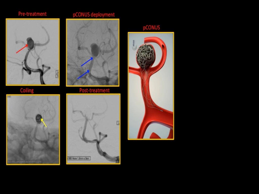 Fig. 6: Case of a basilar artery tip aneurysm (red arrow) treated with coiling (yellow arrow) and a pconus adjunctive device (blue arrows) with successful