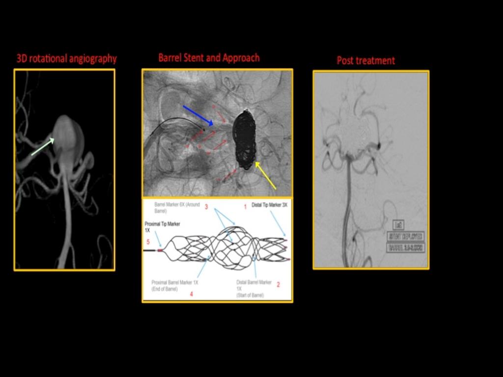 Fig. 7: Case of a basilar tip aneurysm (light green arrow) treated with coiling (yellow arrow) with a barrel stent (blue arrow).