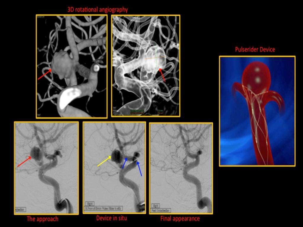 Fig. 8: A case of an elective right supraclinoid internal carotid artery aneurysm (red arrow) treated with a pulserider stenting device (blue arrows) and 8 coils (yellow