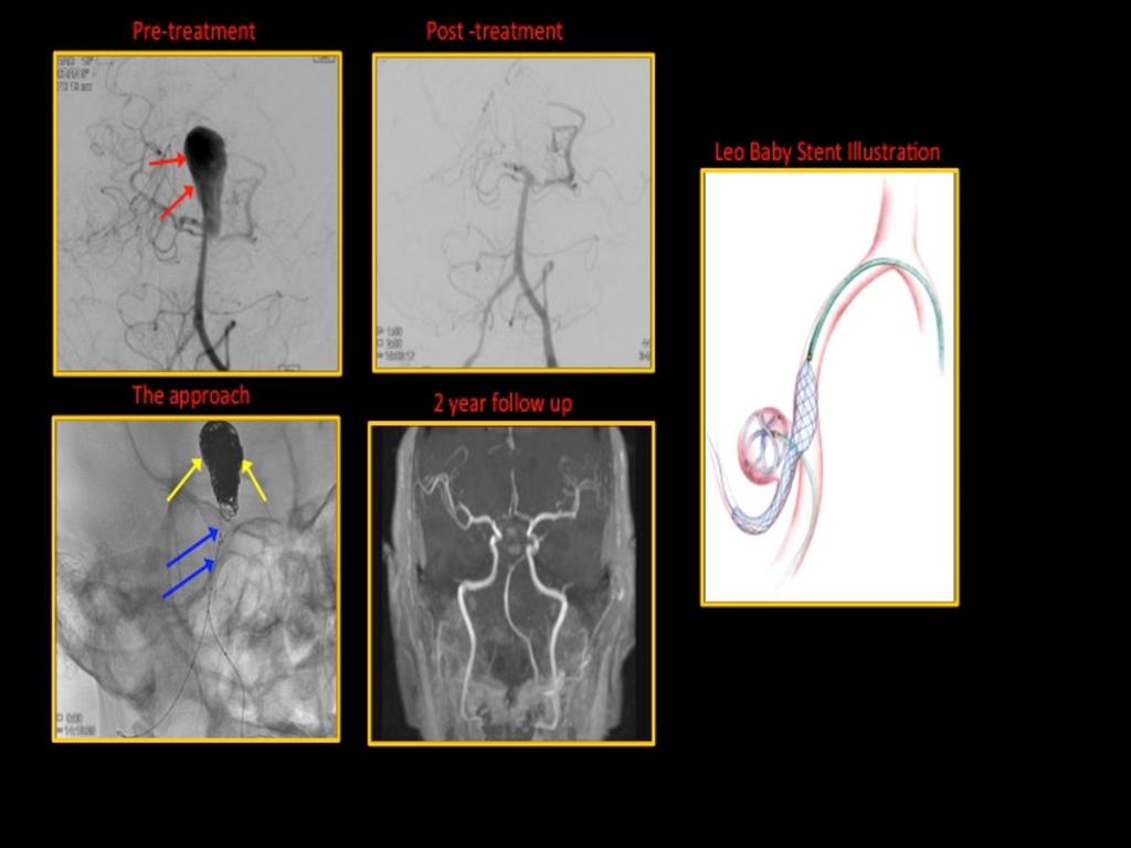 Fig. 9: A case of an incidental partially thrombosed basilar tip aneurysm (red arrows) treated with T-stenting using low profile self-expandable (LEO Baby stent, blue arrows) and coiling (yellow