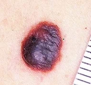 Melanoma If history is doubtful, have low threshold for