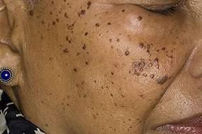 Dermatosis papulosis