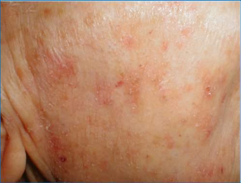 Actinic Keratoses management options Why bother?