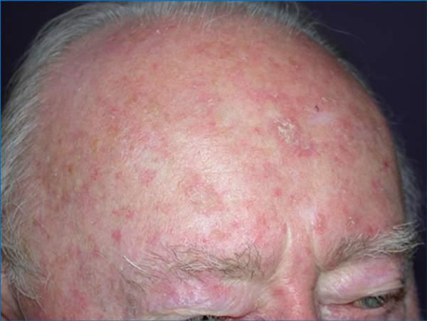 The Field Skin around the AK lesion, which may have been damaged by UV Often red, with telangiectasias Sometimes no visible changes but cells