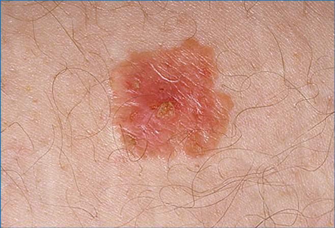 Bowen s disease Erythematous plaque Crust Full thickness dysplasia on histology Treatment