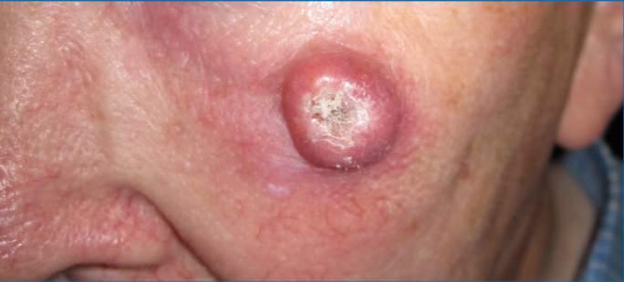 Squamous cell carcinoma Solitary keratotic nodule Risk