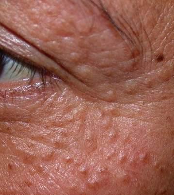Other harmless skin lesions of the Syringomas face Harmless sweat