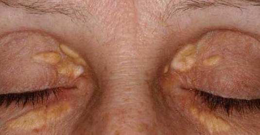Other harmless skin lesions of the Xanthelasma