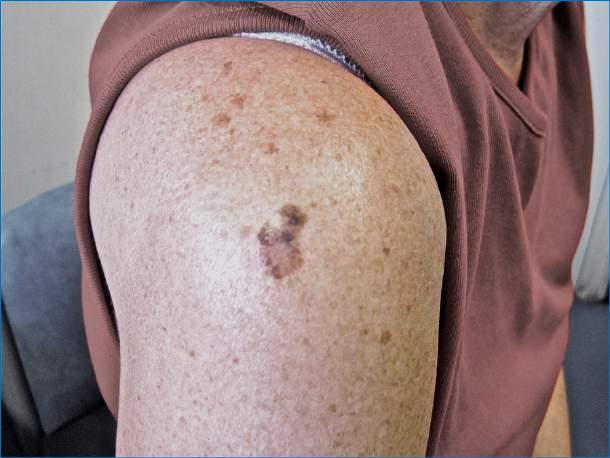 Malignant melanoma Irregularly shaped Variably pigmented Asymmetrical Risk factors: UV exposure /