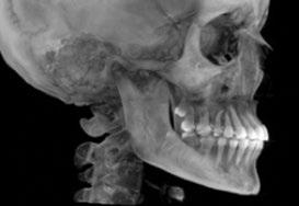 Are temporary anchorage devices truly effective in the treatment of skeletal open bites?