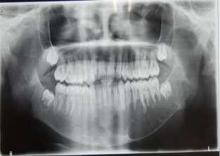 Mandibular occlusal radiograph showed expansion of the buccal and the lingual cortical plate.