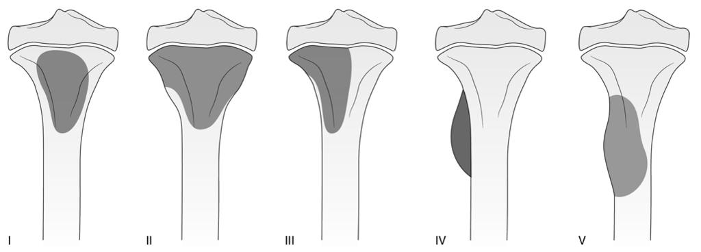 Timothy B. Rapp, MD, et al Figure 1 Illustration of the aneurysmal bone cyst classification developed by Capanna et al, 14 based on morphologic changes visible on radiographs.