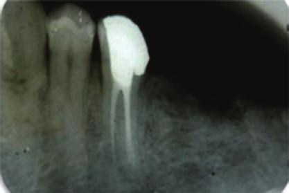 chamber of tooth 45 three separate canal orifices were found (Figure 1).