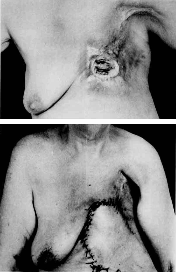 570 CANCER March 1975 Vol. 35 FIGS. 3 (top) and 4 (bottom). Chest wall resection and reconstruction utilizing upper abdominai flap based on the same side.