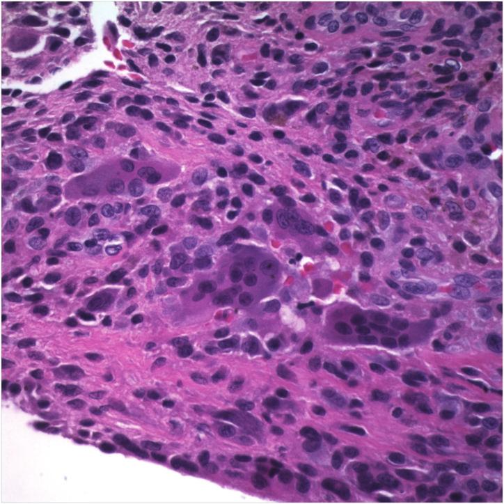 Case Reports in Orthopedics 3 (c) Figure 3: Hematoxylin and eosin stained section demonstrating giant cells and mononuclear cells embedded within a collagenous matrix (600x).