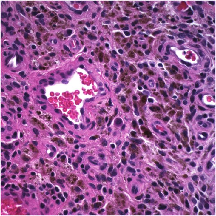 (c) Hematoxylin and eosin stained section demonstrating clusters of xanthomatous cells (600x).