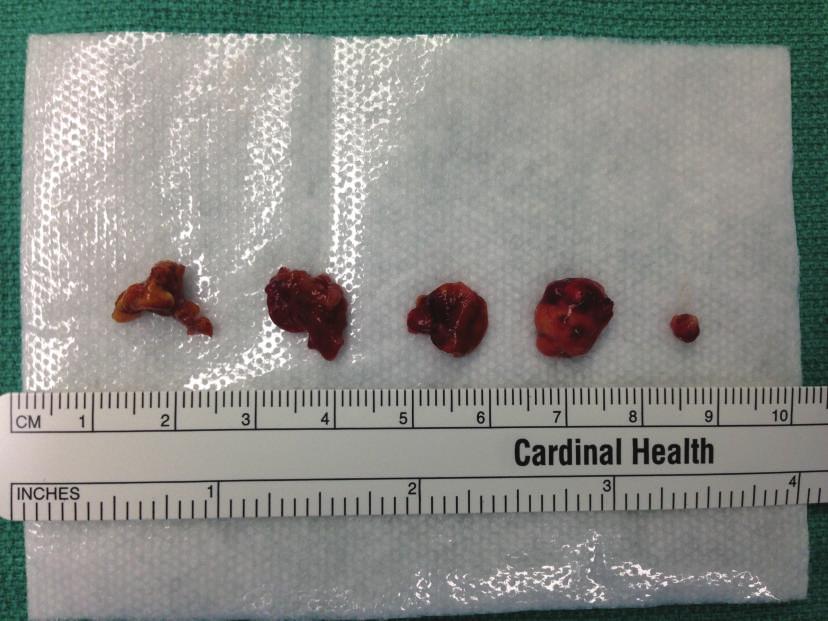 Type II tumors, ones which are not surrounded by one pseudocapsule, were found to have a recurrence rate of 38%.
