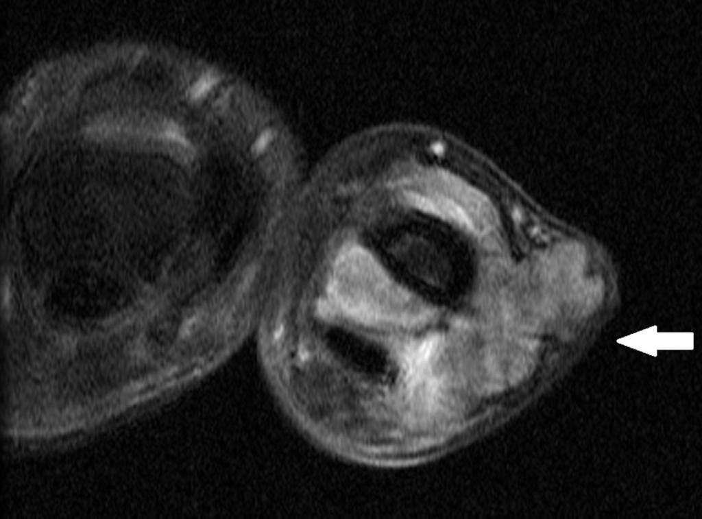 Fig. 8: Giant cell tumor of the tendon sheath in the first finger of a 69-year-old woman. Axial T1-weighted MR image shows a hypointense multilobulated mass which surrounds flexor digitorum tendon.