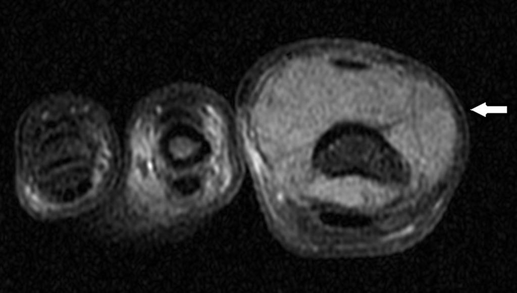 Fig. 16: 38-year-old woman with a giant cell tumor of the tendon sheath in the great toe of the right foot.