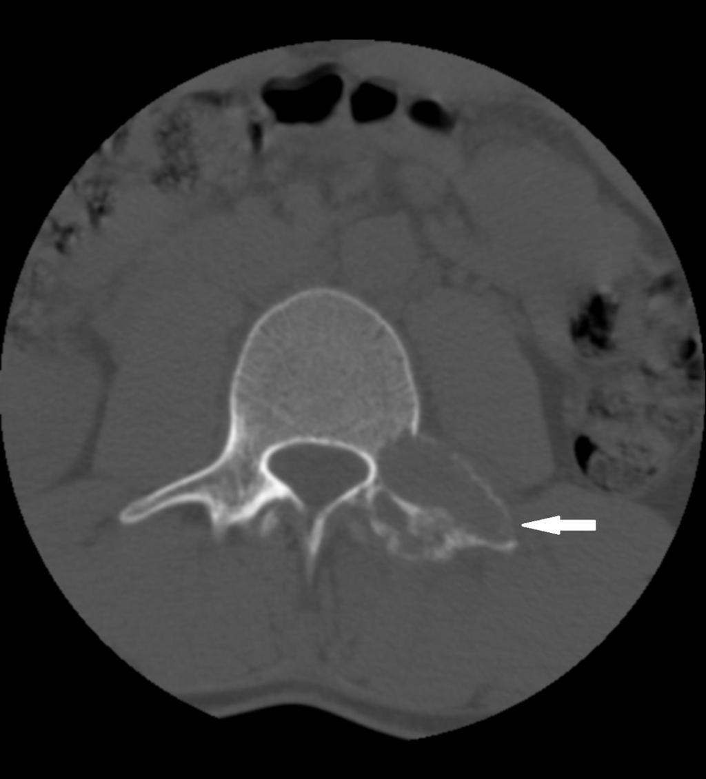 Fig. 3: Axial CT scan, bone window, shows an expansive lytic lesion which affects the left transverse apophysis, pedicle and superior