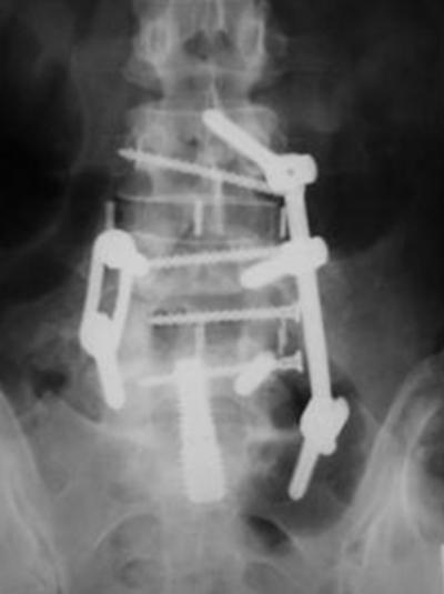 Figure 2 Figure 2: Postoperative anterior-posterior radiograph showing anterior stabilization with XLIF interbody implants at L3-4 and L4-5 and AxiaLIF at L5-S1 (Trans1, Wilmington, NC).
