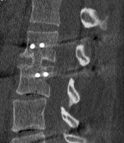Slip in those with spondylolisthesis was reduced by an average 3.4mm, also maintained through the 6 month follow-up. Fusion was assessed by Lenke score ( 18 ) with averages of 2.3 at 3 months and 2.