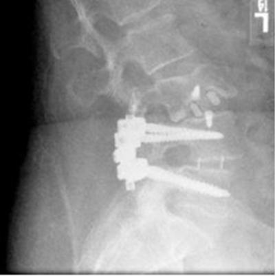 Figure 5 Figure 4: Lateral X-ray at 2 weeks post-op identifying vertebral body fracture with implant subsidence.