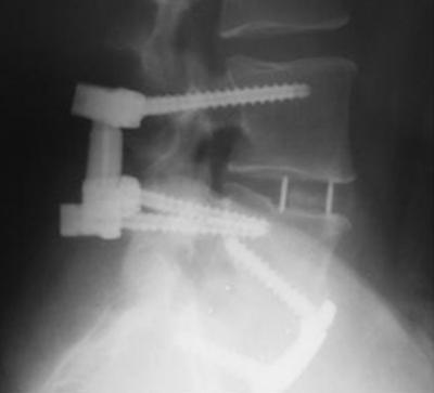 DISCUSSION Adjacent segment disease has long been a concern of spinal surgeons treating patients with lumbar fusions.