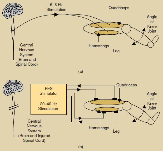 5 Figure 1: Activating quadriceps and hamstring muscle via a) natural means in a healthy individual, and b) using FES in individual with damaged spinal cord [20]. 2.1.1 Nature of FES Systems Two main components of FES systems are the stimulator and the electrodes.