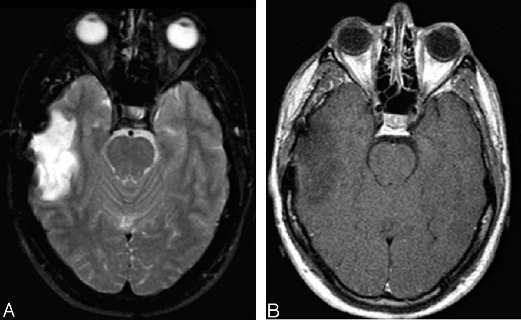 No evidence of abnormal enhancement and of either subependymal or leptomeningeal spread is seen on the coronal T1-weighted postgadolinium (C) image.